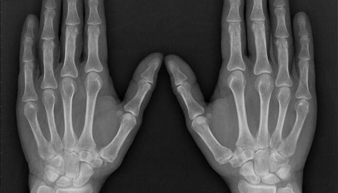 x-ray for diagnosis of arthritis and arthrosis