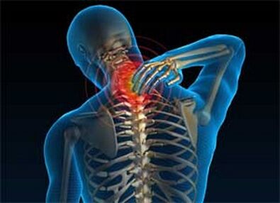 Neck pain is a common symptom of osteochondrosis