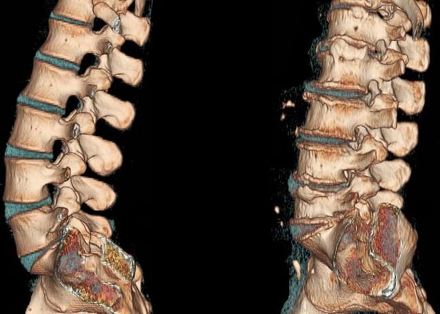 Lumbar osteochondrosis