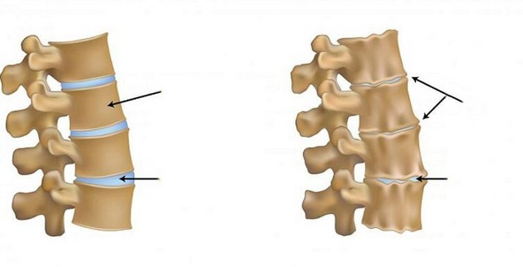 ischemic syndrome for osteochondrosis