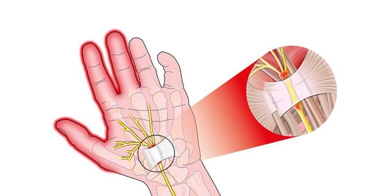 Pain in the joints of the fingers with rifactrosis