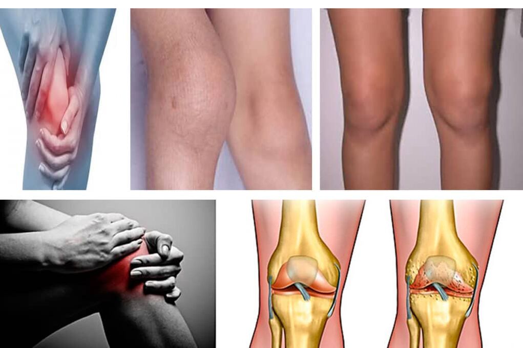 symptoms of osteoarthritis of the knee